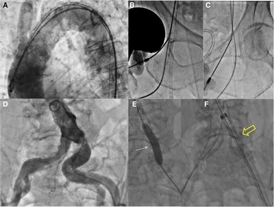 Case report of snaring-assisted TAVR under cerebral embolic protection: the “Chaperone” with “Top Hat” technique